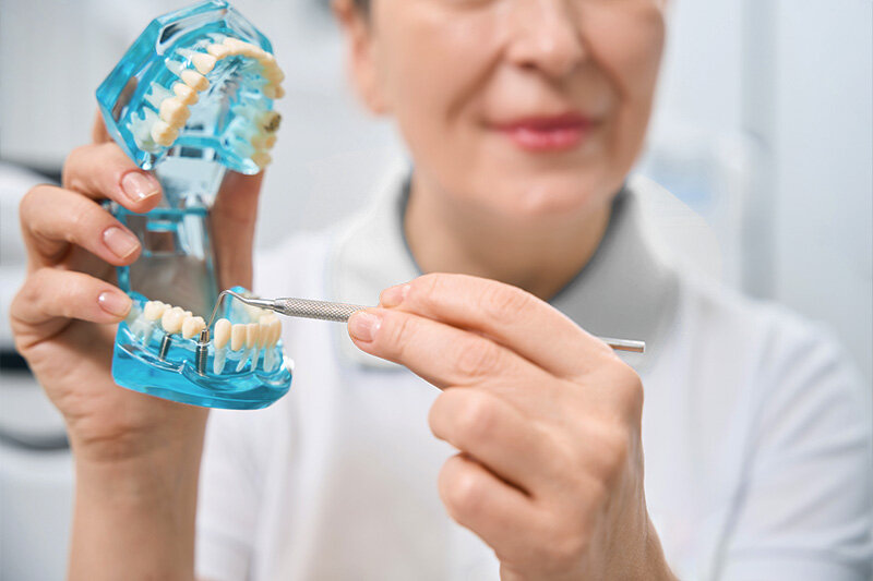 Beneficios de los Implantes Dentales