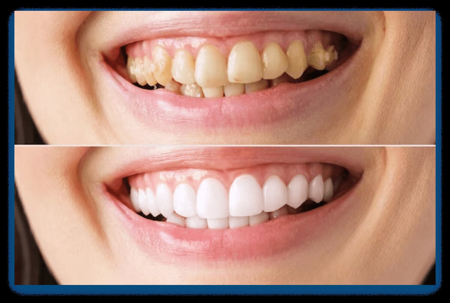 Blanqueamiento Dental: Un Clásico Reinventado
