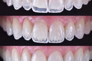 Carillas dentales: beneficios, riesgos, costos y medicinas recomendadas tras el procedimiento