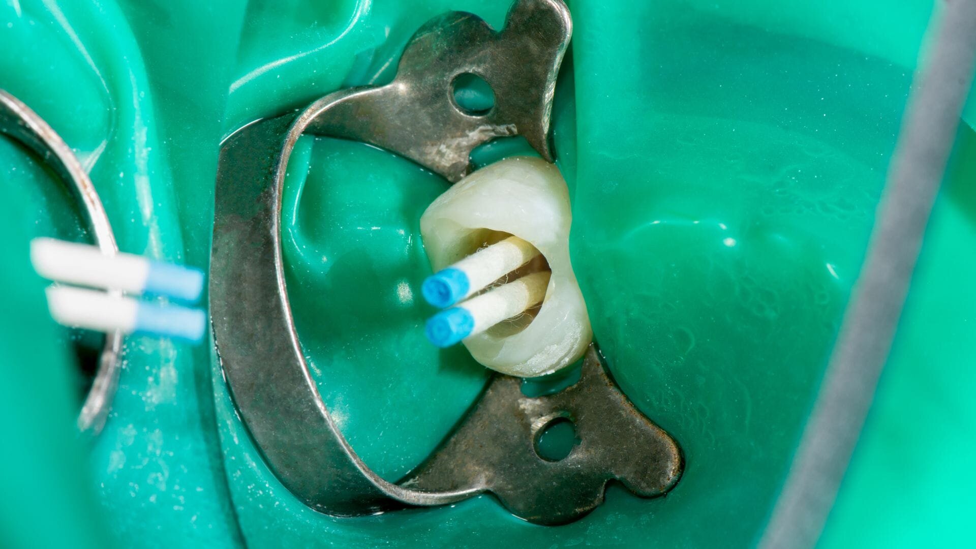 Complicaciones Potenciales y Cuándo Consultar al Dentista