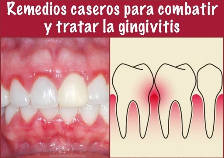 Cuidados en Casa para Combatir la Gingivitis