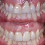 Dolor en las encías: medicinas más recomendadas y tratamientos dentales que ofrecen soluciones