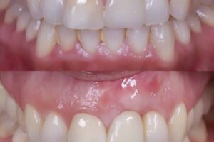 Dolor en las encías: medicinas más recomendadas y tratamientos dentales que ofrecen soluciones