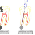 Endodoncia: qué es, cuándo se recomienda y medicamentos utilizados durante el procedimiento