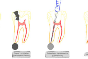 Endodoncia: qué es, cuándo se recomienda y medicamentos utilizados durante el procedimiento