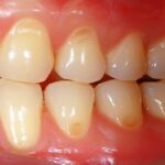 Enfermedades dentales que afectan a los niños: síntomas, prevención y tratamientos recomendados