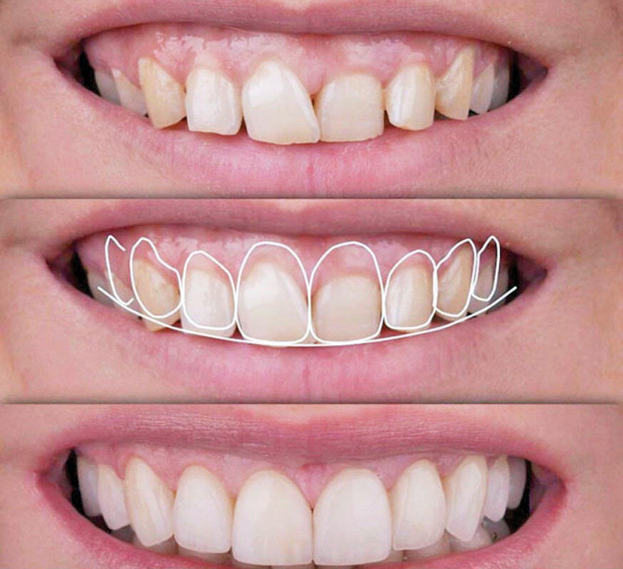 Gingivectomía Estética: Redefiniendo la Sonrisa