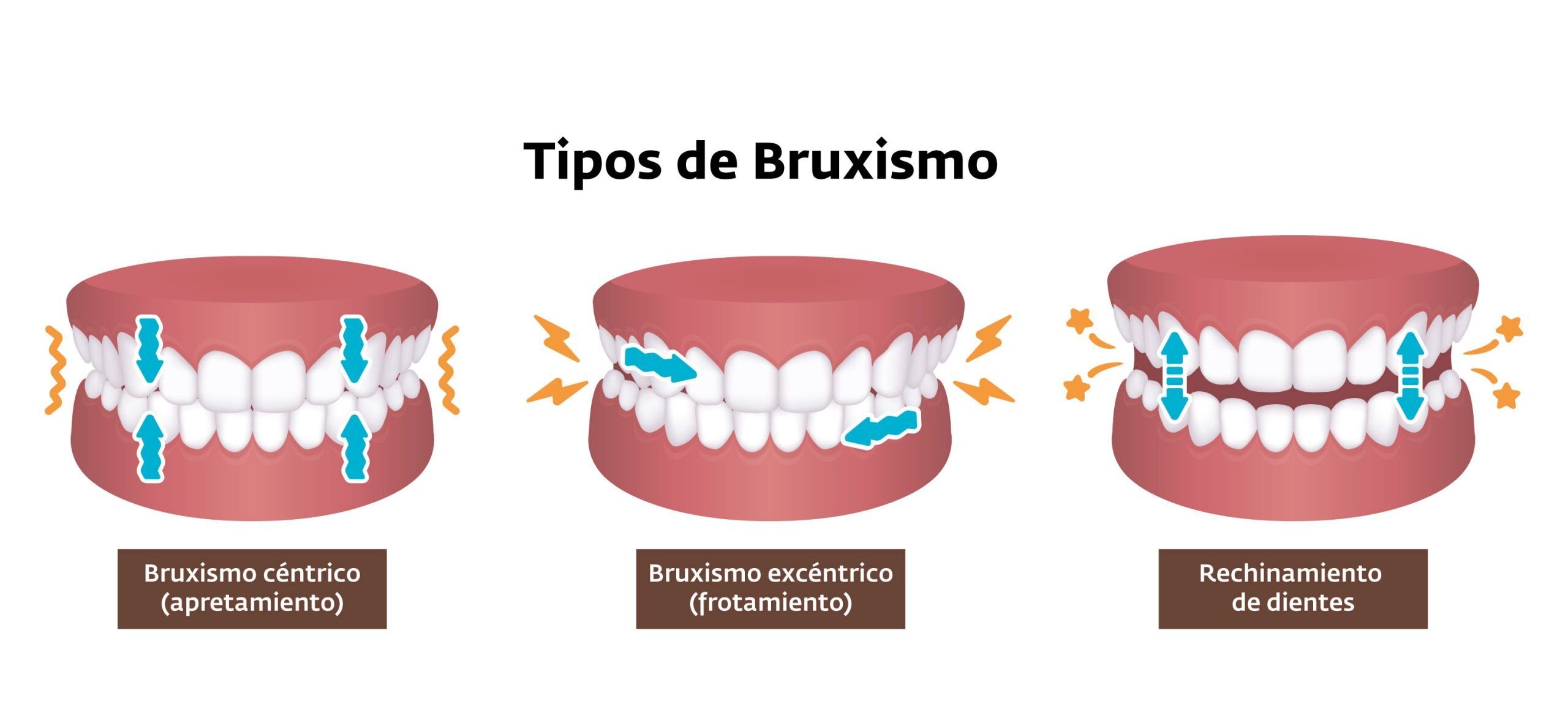 Guía Paso a Paso para el Manejo del Bruxismo