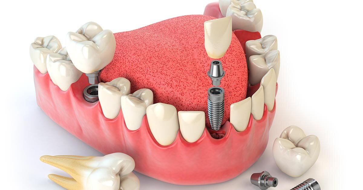 Implantes Dentales: Reemplazo Permanente de Dientes Perdidos