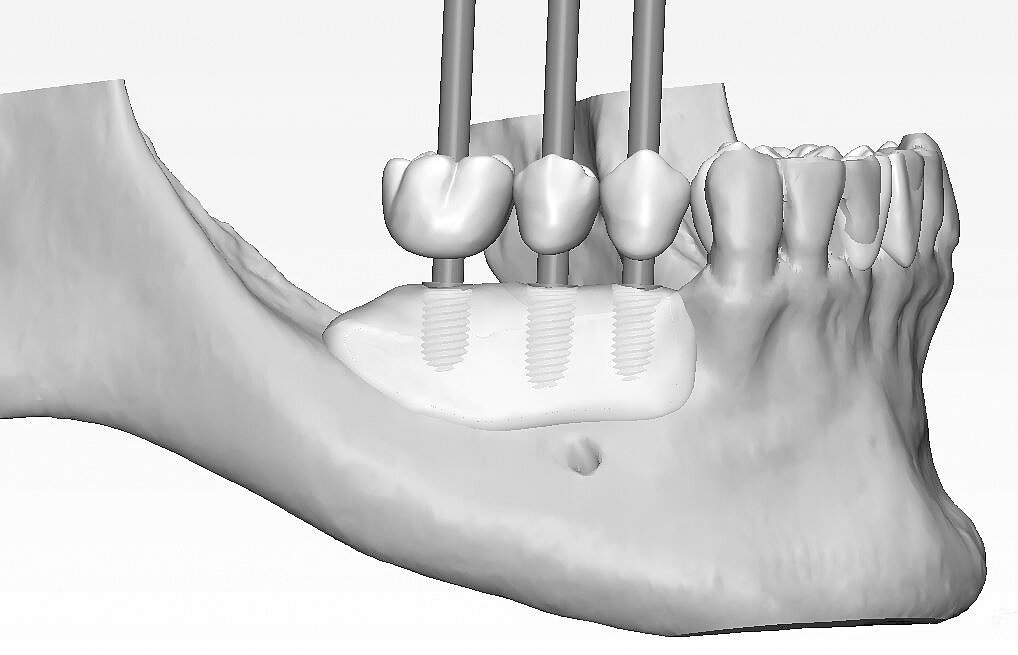La Importancia de la Regeneración Ósea en Odontología