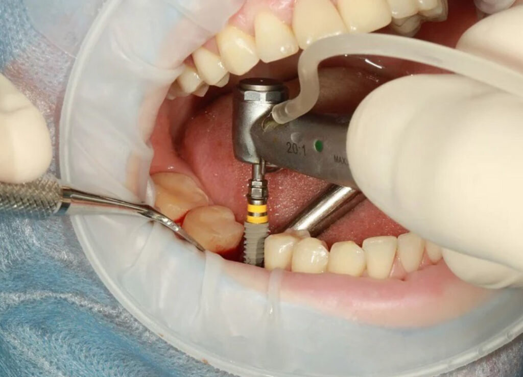 Manejo del Dolor Post-Colocación de Prótesis Dentales: Opciones Farmacológicas