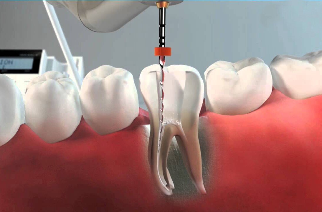Medicamentos Comunes Después de una Endodoncia