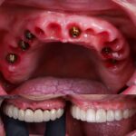 Medicamentos más efectivos tras cirugía de implantes y tratamientos dentales complementarios