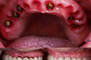 Medicamentos más efectivos tras cirugía de implantes y tratamientos dentales complementarios