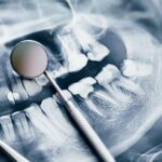 Medicamentos más efectivos tras cirugía dental compleja y tratamientos odontológicos