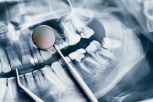 Medicamentos más efectivos tras cirugía dental compleja y tratamientos odontológicos