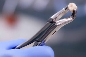 Medicamentos para dolor tras extracción dental y tratamientos más efectivos