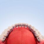 Medicamentos para dolor tras ortodoncia lingual y tratamientos dentales efectivos