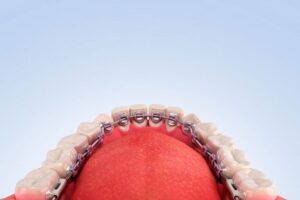 Medicamentos para dolor tras ortodoncia lingual y tratamientos dentales efectivos