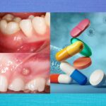 Medicamentos para reducir dolor tras cirugía de encías y cuidados posteriores necesarios