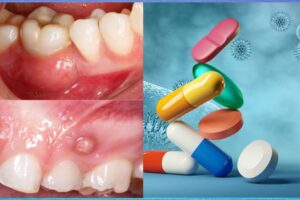 Medicamentos para reducir dolor tras cirugía de encías y cuidados posteriores necesarios