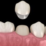 Medicinas más comunes tras endodoncia y cuidados posteriores en odontología