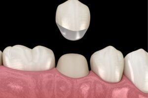 Medicinas más comunes tras endodoncia y cuidados posteriores en odontología