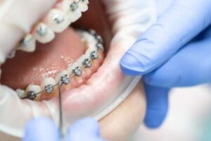 Medicinas más efectivas tras ortodoncia y cuidados posteriores en odontología