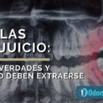 Medicinas más recomendadas tras extracción de muela del juicio y cuidados necesarios