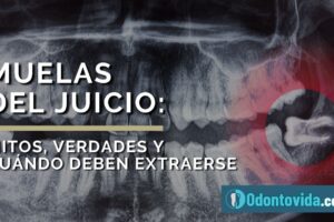 Medicinas más recomendadas tras extracción de muela del juicio y cuidados necesarios