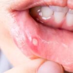 Medicinas para el tratamiento de úlceras bucales recurrentes y cuidados dentales esenciales