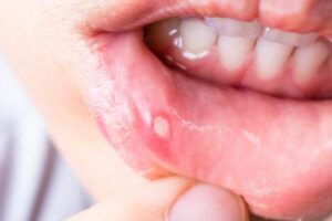 Medicinas para el tratamiento de úlceras bucales recurrentes y cuidados dentales esenciales