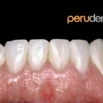 Medicinas para evitar infecciones tras cirugía dental y tratamientos complementarios