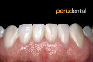 Medicinas para evitar infecciones tras cirugía dental y tratamientos complementarios