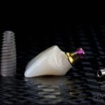 Medicinas para la cicatrización rápida tras un implante dental: guía de tratamientos dentales