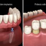 Medicinas para la recuperación tras prótesis dentales y tratamientos odontológicos