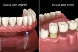 Medicinas para la recuperación tras prótesis dentales y tratamientos odontológicos