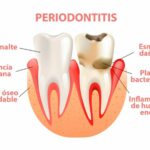 Medicinas para tratar inflamación tras tratamiento periodontal y cuidados recomendados
