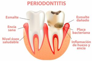 Medicinas para tratar inflamación tras tratamiento periodontal y cuidados recomendados
