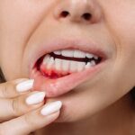 Medicinas para tratar la estomatitis y tratamientos dentales que ayudan a prevenir recaídas