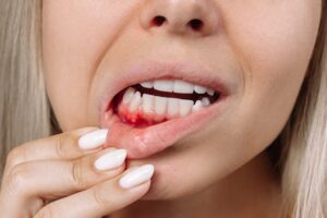 Medicinas para tratar la estomatitis y tratamientos dentales que ayudan a prevenir recaídas