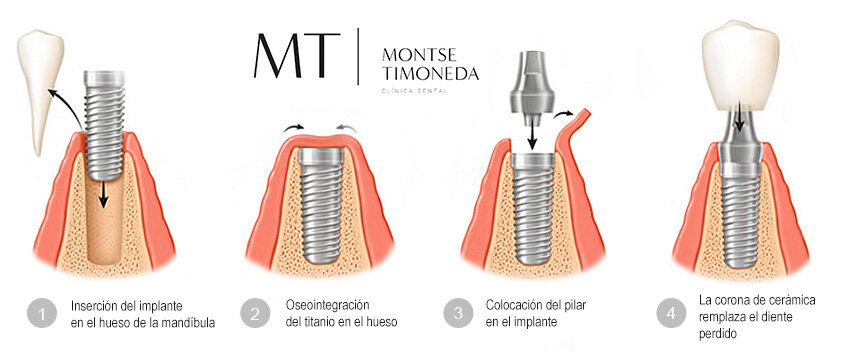 Medicinas Recomendadas Después de la Colocación de Implantes Inmediatos
