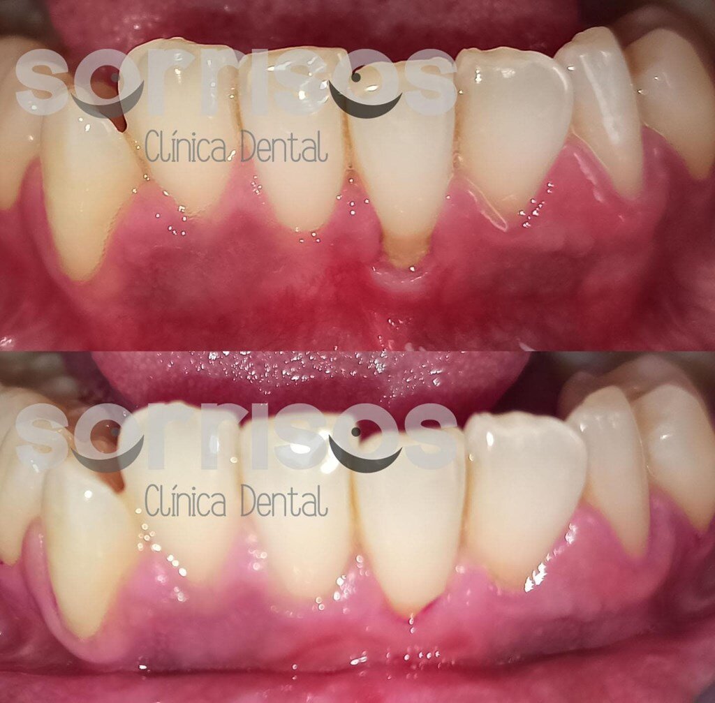 Medicinas Recomendadas en Odontología para la Gingivitis