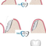 Medicinas recomendadas tras cirugía de injerto óseo y tratamientos complementarios