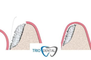 Medicinas recomendadas tras cirugía de injerto óseo y tratamientos complementarios