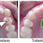 Medicinas recomendadas tras extracciones complicadas y tratamientos dentales complementarios