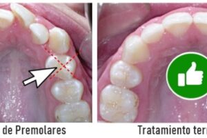 Medicinas recomendadas tras extracciones complicadas y tratamientos dentales complementarios