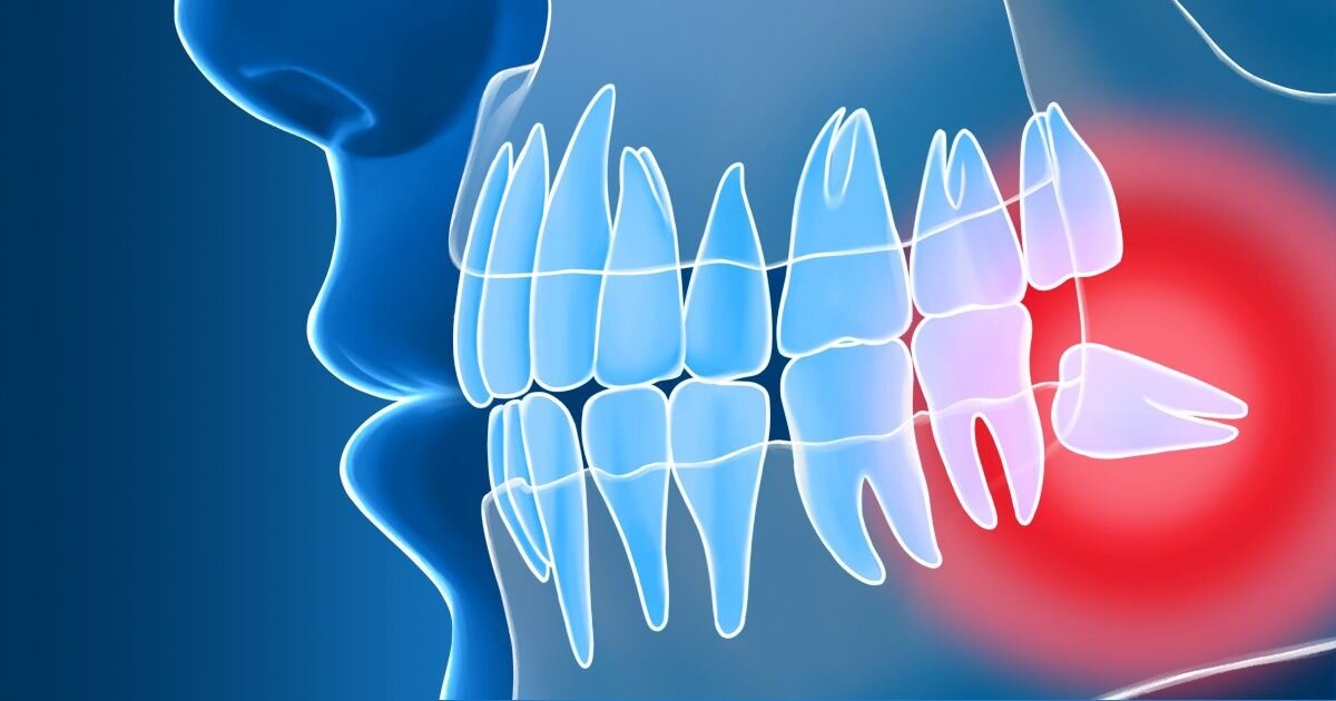 ¿Por qué se extraen las muelas del juicio?