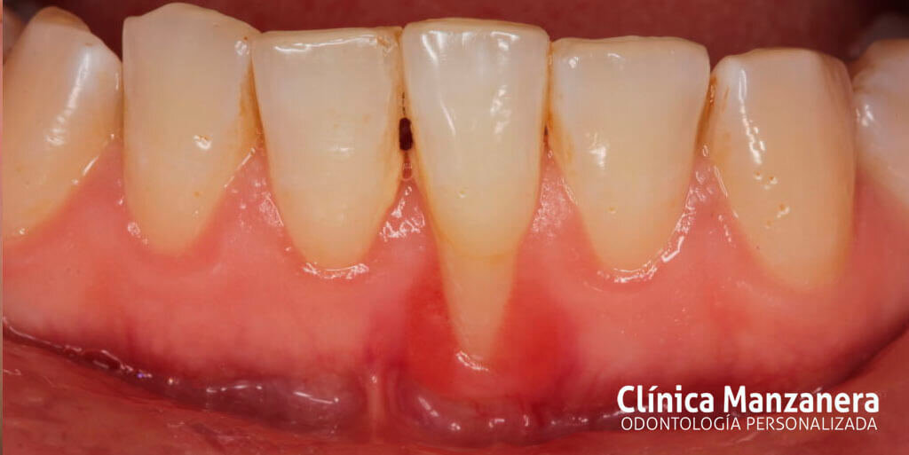 ¿Qué causa la inflamación de las encías?