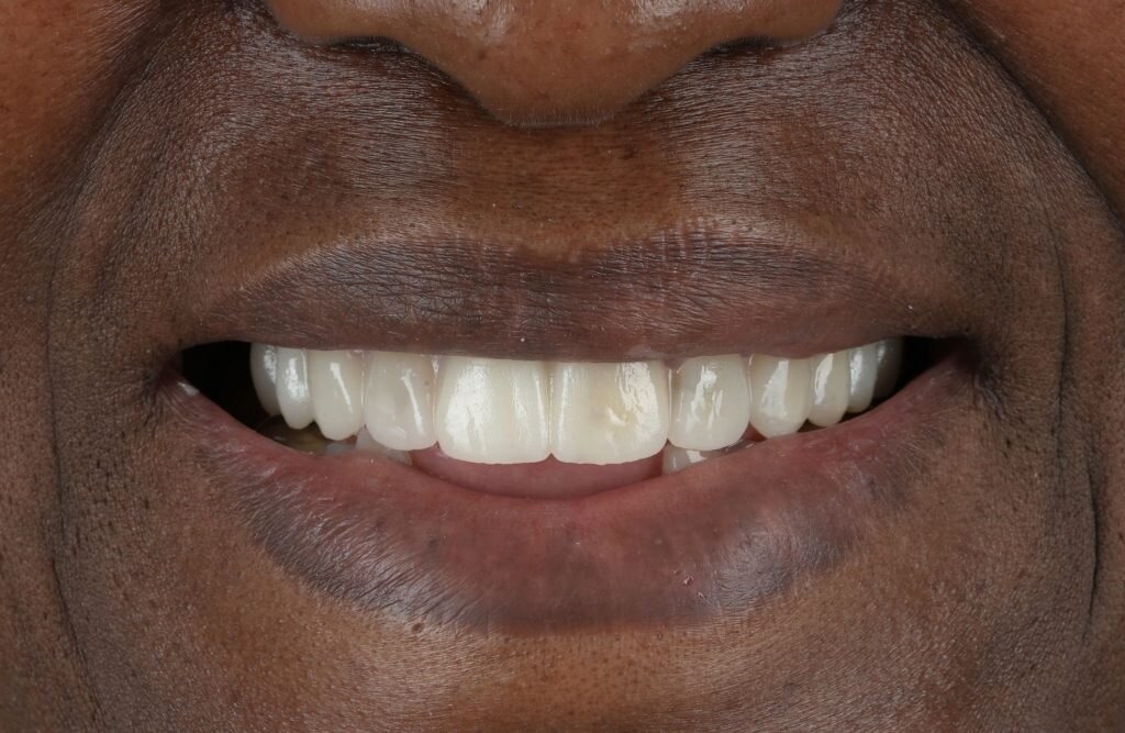 ¿Qué es el Diseño de Sonrisa Digital (DSD)?